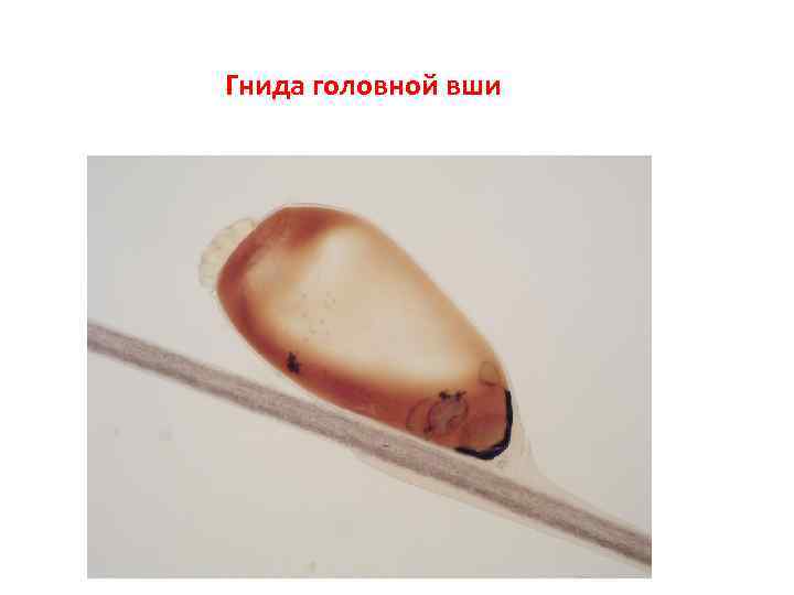 Гнида головной вши 