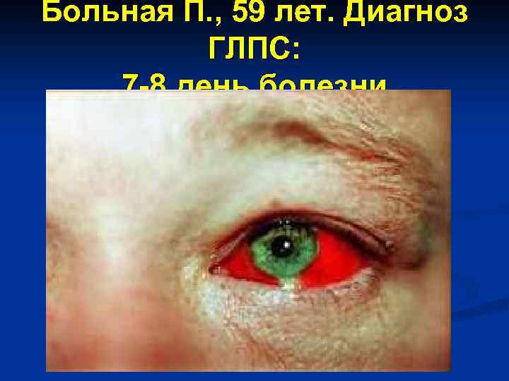 Больная П. , 59 лет. Диагноз ГЛПС: 7 -8 день болезни 