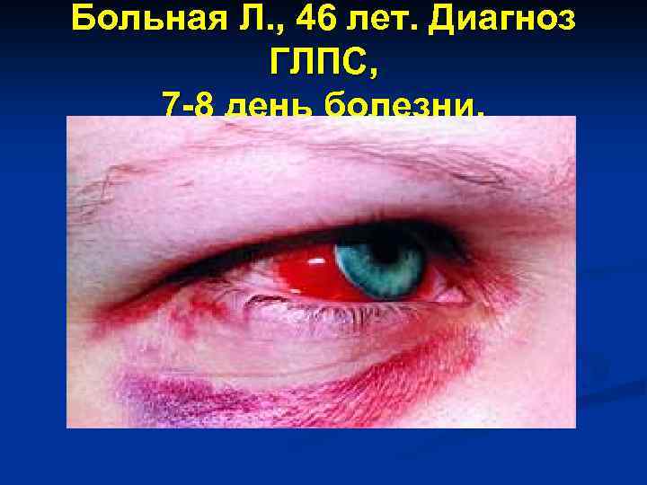 Больная Л. , 46 лет. Диагноз ГЛПС, 7 -8 день болезни. 