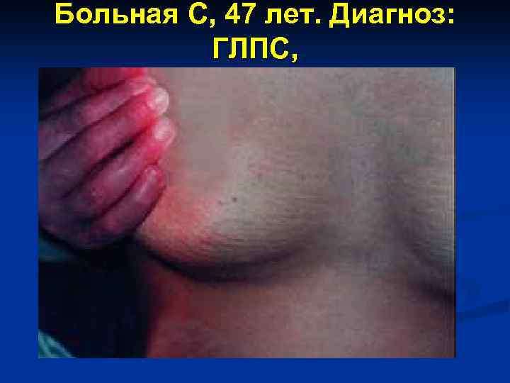 Больная С, 47 лет. Диагноз: ГЛПС, 7 -8 день болезни. 