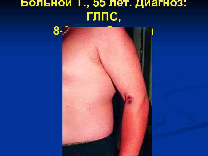 Больной Т. , 55 лет. Диагноз: ГЛПС, 8 -9 день болезни 