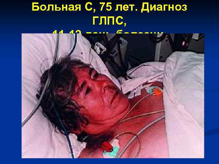 Больная С, 75 лет. Диагноз ГЛПС, 11 -12 день болезни. 