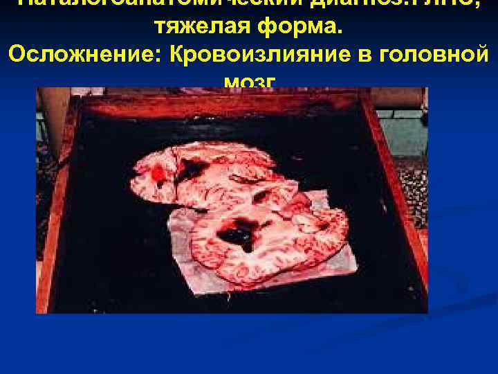 Паталогоанатомический диагноз: ГЛПС, тяжелая форма. Осложнение: Кровоизлияние в головной мозг 