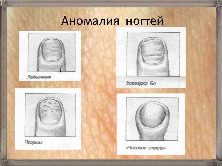  Аномалия ногтей ). 