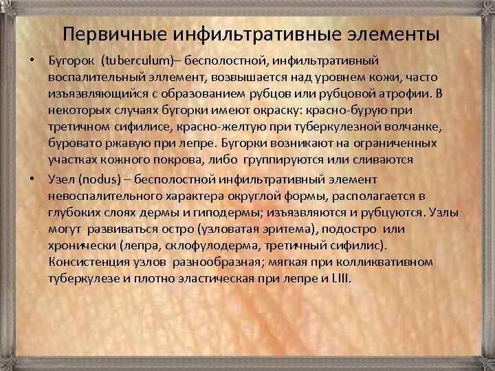  Первичные инфильтративные элементы • Бугорок (tuberculum)– бесполостной, инфильтративный воспалительный эллемент, возвышается над уровнем
