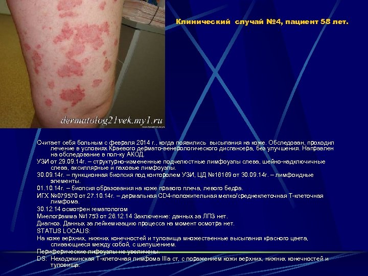 Клинический случай № 4, пациент 58 лет. Считает себя больным с февраля 2014 г.