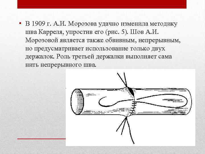  • В 1909 г. А. И. Морозова удачно изменила методику шва Карреля, упростив