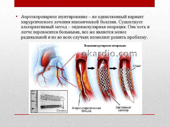  • Аортокоронарное шунтирование – не единственный вариант хирургического лечения ишемической болезни. Существует альтернативный
