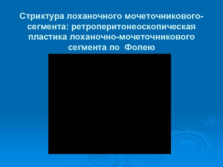 Стриктура лоханочного мочеточниковогосегмента: ретроперитонеоскопическая пластика лоханочно-мочеточникового сегмента по Фолею 