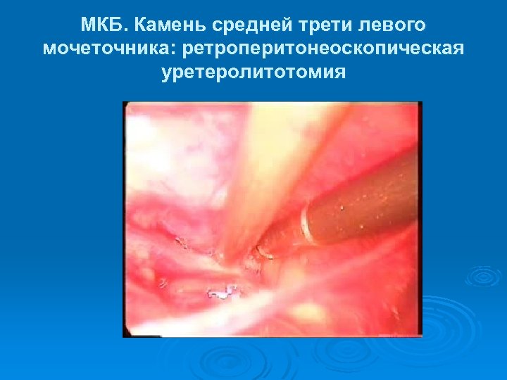 МКБ. Камень средней трети левого мочеточника: ретроперитонеоскопическая уретеролитотомия 