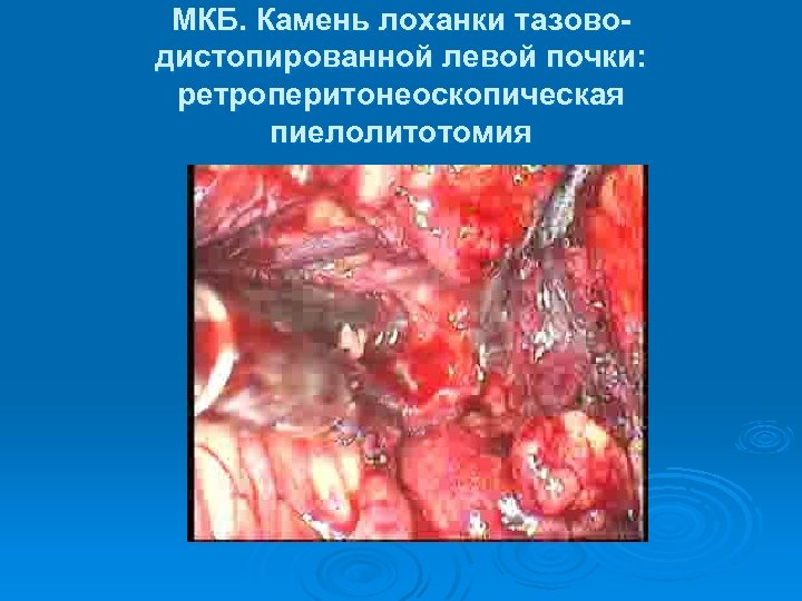 МКБ. Камень лоханки тазоводистопированной левой почки: ретроперитонеоскопическая пиелолитотомия 