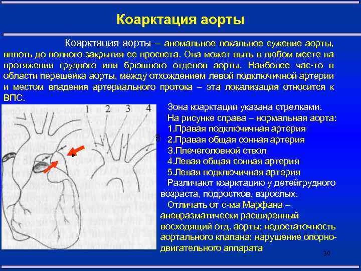 Коарктация аорты – аномальное локальное сужение аорты, вплоть до полного закрытия ее просвета. Она