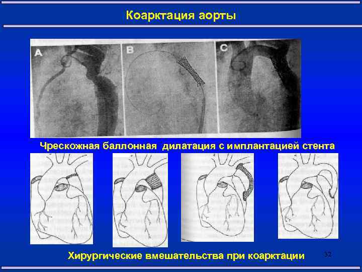 Коарктация аорты Чрескожная баллонная дилатация с имплантацией стента Хирургические вмешательства при коарктации 32 