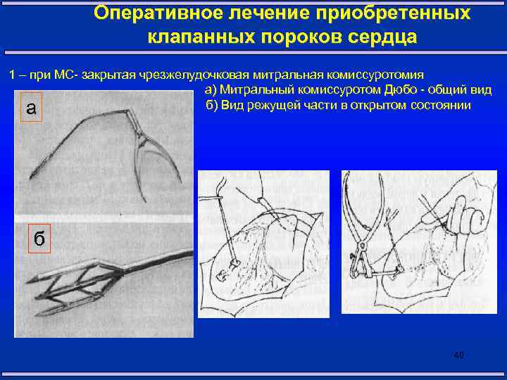 Оперативное лечение приобретенных клапанных пороков сердца 1 – при МС- закрытая чрезжелудочковая митральная комиссуротомия