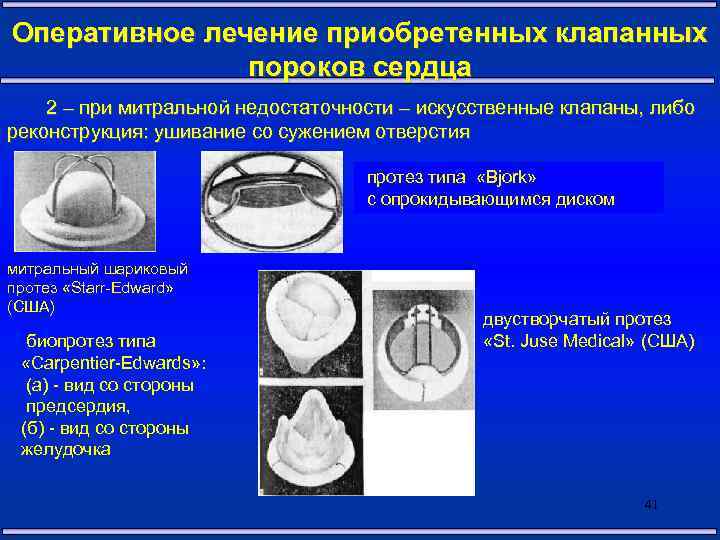 Оперативное лечение приобретенных клапанных пороков сердца 2 – при митральной недостаточности – искусственные клапаны,