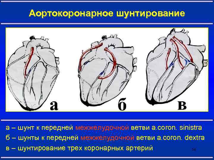 Аортокоронарное шунтирование а – шунт к передней межжелудочной ветви a. coron. sinistra б –