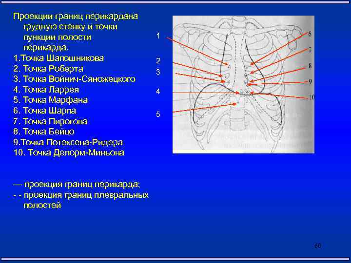Проекции границ перикардана грудную стенку и точки пункции полости перикарда. 1. Точка Шапошникова 2.
