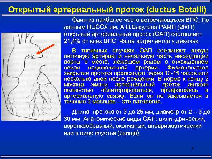 Открытый артериальный проток (ductus Botalli) Один из наиболее часто встречающихся ВПС. По данным НЦССХ