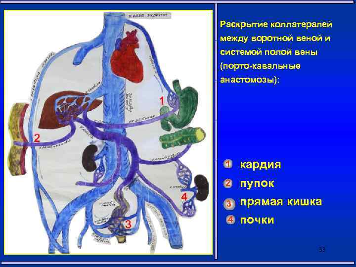 Раскрытие коллатералей между воротной веной и системой полой вены (порто-кавальные анастомозы): 1 кардия 2