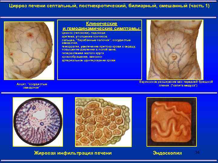 Хирургические заболевания печени презентация