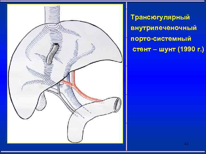 Трансюгулярный внутрипеченочный порто-системный стент – шунт (1990 г. ) 42 