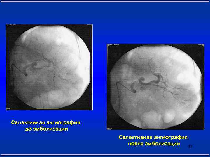 Селективная ангиография до эмболизации Селективная ангиография после эмболизации 55 