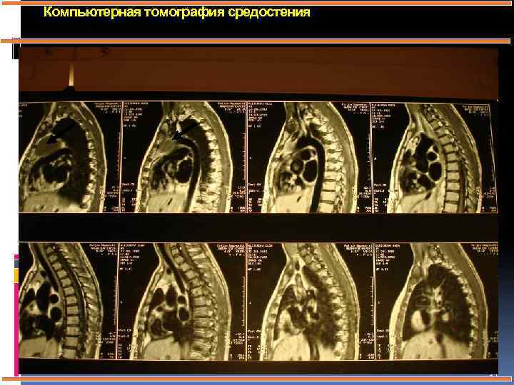 Компьютерная томография средостения 15 