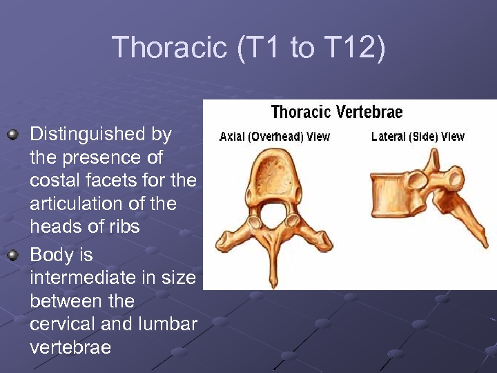 Thoracic (T 1 to T 12) Distinguished by the presence of costal facets for
