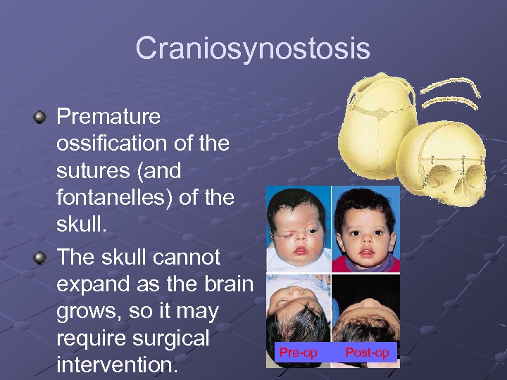 Craniosynostosis Premature ossification of the sutures (and fontanelles) of the skull. The skull cannot