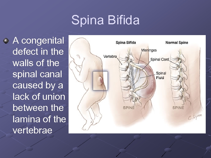 Spina Bifida A congenital defect in the walls of the spinal caused by a