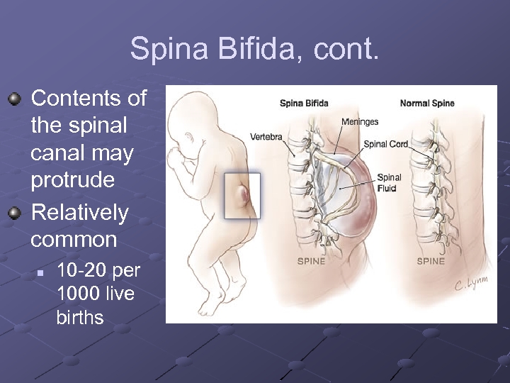 Spina Bifida, cont. Contents of the spinal canal may protrude Relatively common n 10