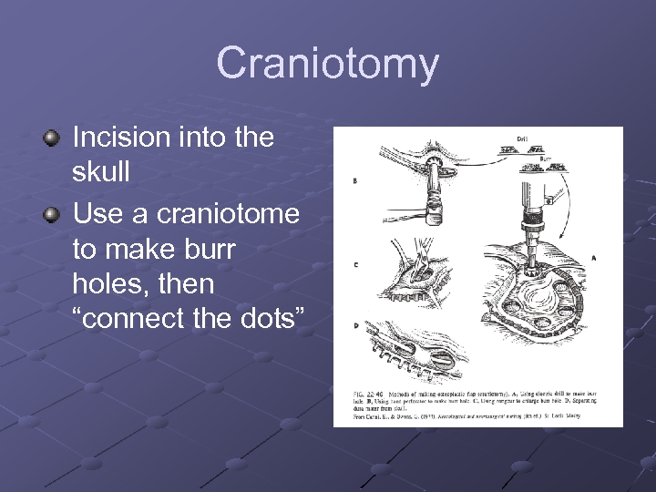 Craniotomy Incision into the skull Use a craniotome to make burr holes, then “connect