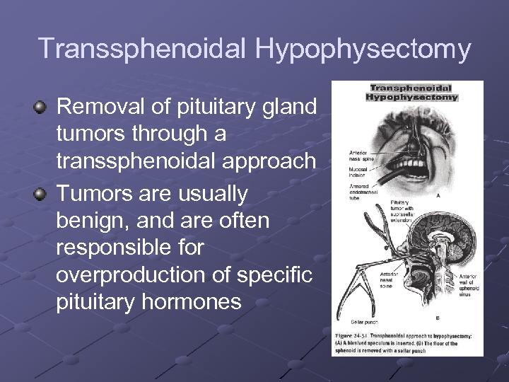 Transsphenoidal Hypophysectomy Removal of pituitary gland tumors through a transsphenoidal approach Tumors are usually
