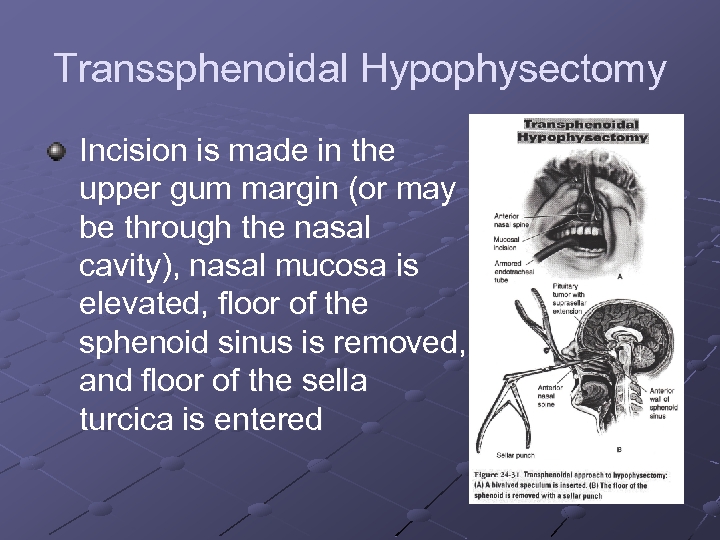 Transsphenoidal Hypophysectomy Incision is made in the upper gum margin (or may be through