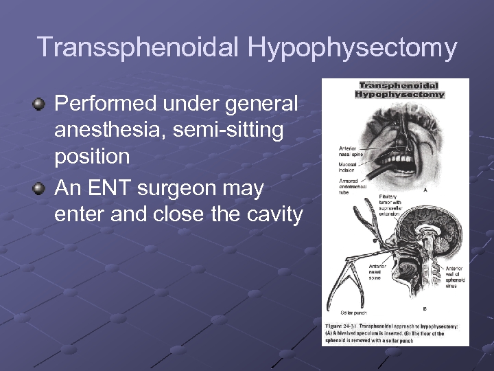 Transsphenoidal Hypophysectomy Performed under general anesthesia, semi-sitting position An ENT surgeon may enter and