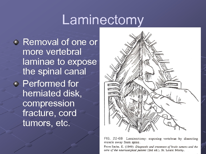 Laminectomy Removal of one or more vertebral laminae to expose the spinal canal Performed