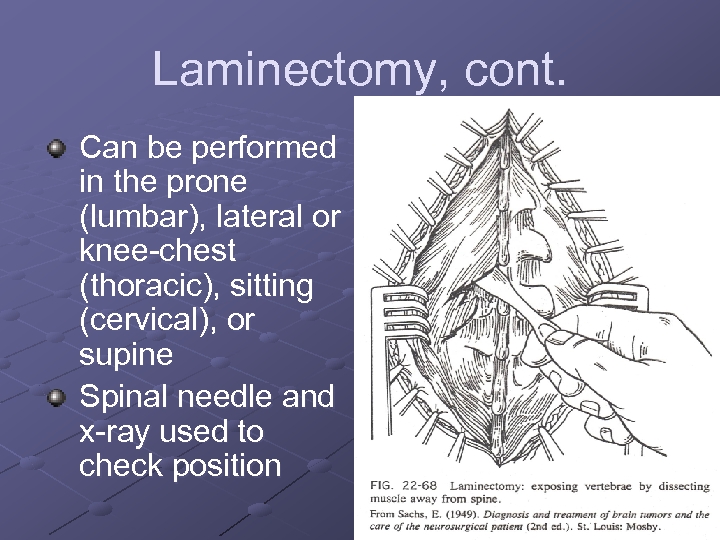 Laminectomy, cont. Can be performed in the prone (lumbar), lateral or knee-chest (thoracic), sitting