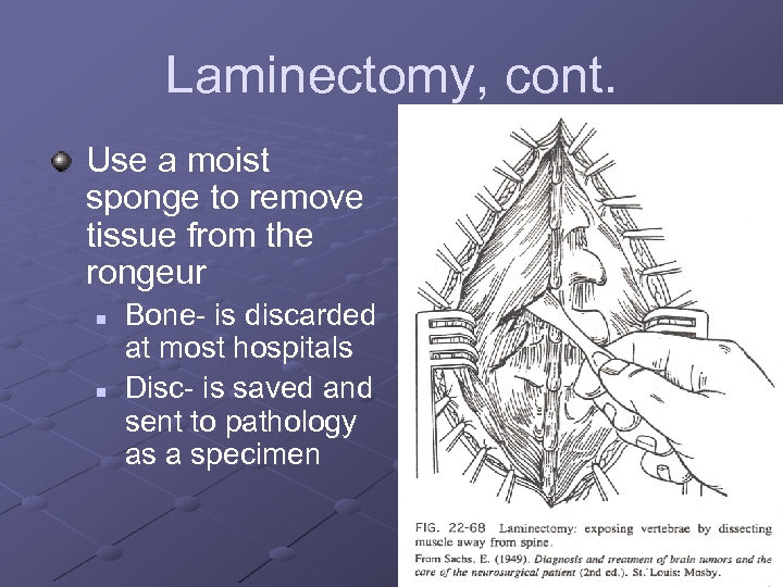 Laminectomy, cont. Use a moist sponge to remove tissue from the rongeur n n