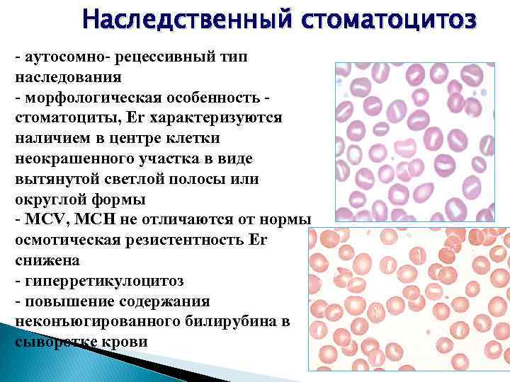 Наследственный стоматоцитоз - аутосомно- рецессивный тип наследования - морфологическая особенность стоматоциты, Er характеризуются наличием