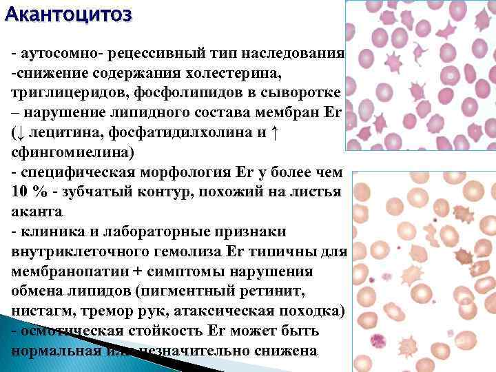 Акантоцитоз - аутосомно- рецессивный тип наследования -снижение содержания холестерина, триглицеридов, фосфолипидов в сыворотке –