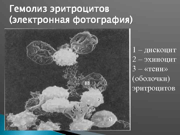 Гемолиз эритроцитов (электронная фотография) 1 – дискоцит 2 – эхиноцит 3 – «тени» (оболочки)