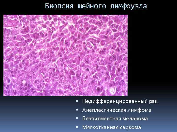 Биопсия шейного лимфоузла Недифференцированный рак Анапластическая лимфома Безпигментная меланома Мягкотканная саркома 