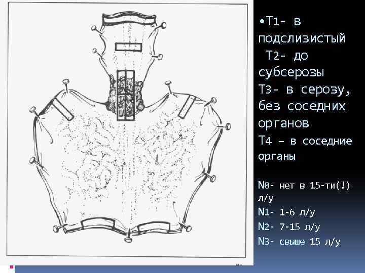  • Т 1 - в подслизистый Т 2 - до субсерозы Т 3