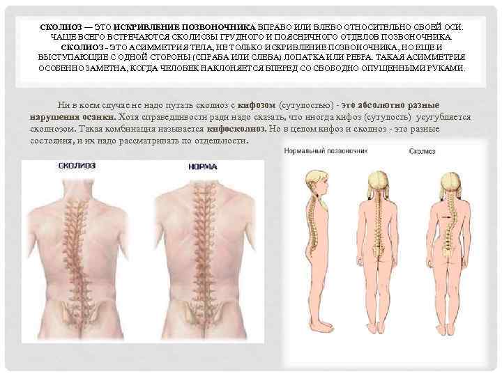 СКОЛИОЗ — ЭТО ИСКРИВЛЕНИЕ ПОЗВОНОЧНИКА ВПРАВО ИЛИ ВЛЕВО ОТНОСИТЕЛЬНО СВОЕЙ ОСИ. ЧАЩЕ ВСЕГО ВСТРЕЧАЮТСЯ