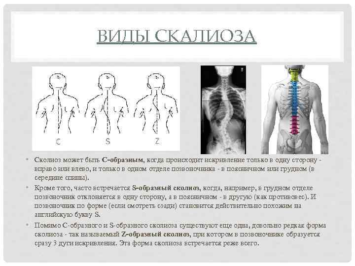 ВИДЫ СКАЛИОЗА • Сколиоз может быть С-образным, когда происходит искривление только в одну сторону