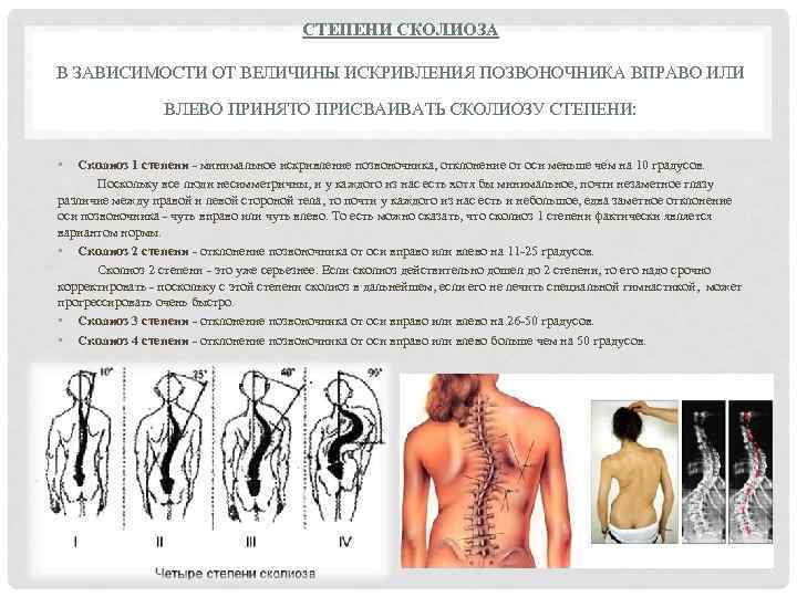 СТЕПЕНИ СКОЛИОЗА В ЗАВИСИМОСТИ ОТ ВЕЛИЧИНЫ ИСКРИВЛЕНИЯ ПОЗВОНОЧНИКА ВПРАВО ИЛИ ВЛЕВО ПРИНЯТО ПРИСВАИВАТЬ СКОЛИОЗУ