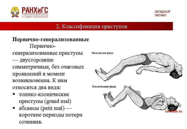 ЗАПАДНЫЙ ФИЛИАЛ 2. Классификация приступов Первично-генерализованные Первичногенерализованные приступы — двусторонние симметричные, без очаговых проявлений