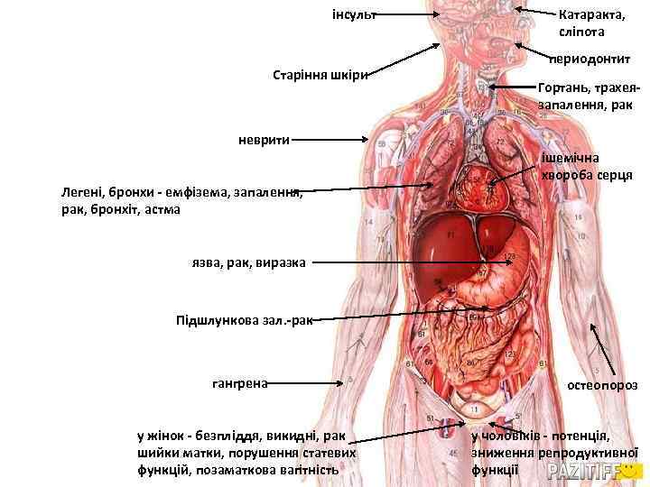 інсульт Старіння шкіри Катаракта, сліпота периодонтит Гортань, трахеязапалення, рак неврити Легені, бронхи - емфізема,