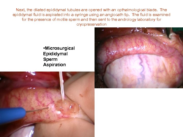 Next, the dilated epididymal tubules are opened with an opthalmological blade. The epididymal fluid
