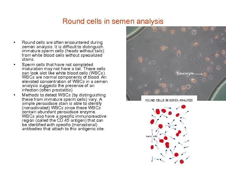 Round cells in semen analysis • • • Round cells are often encountered during